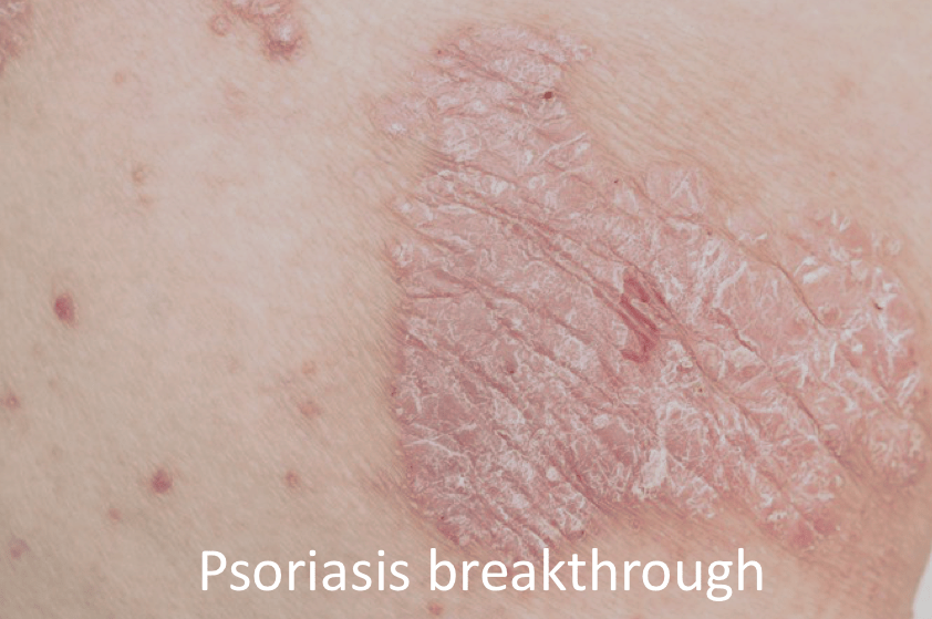 Psoriasis breakthrough