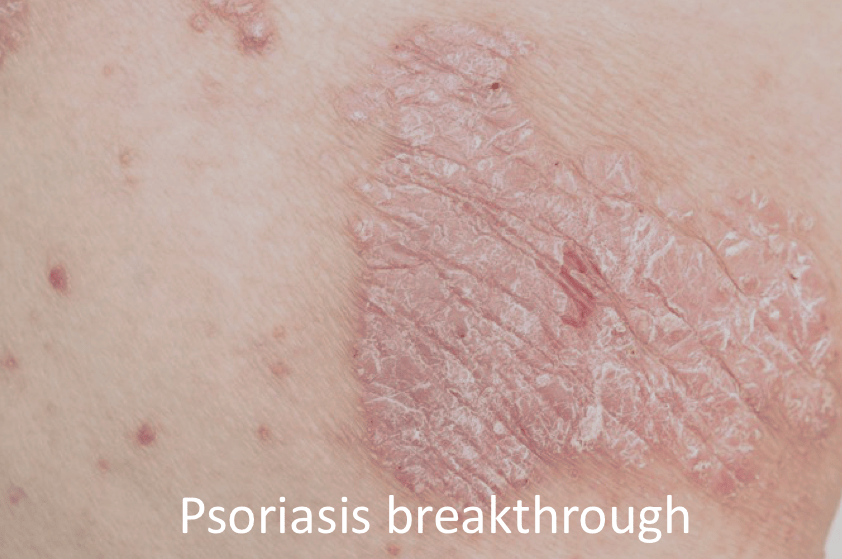 New Psoriasis treatment