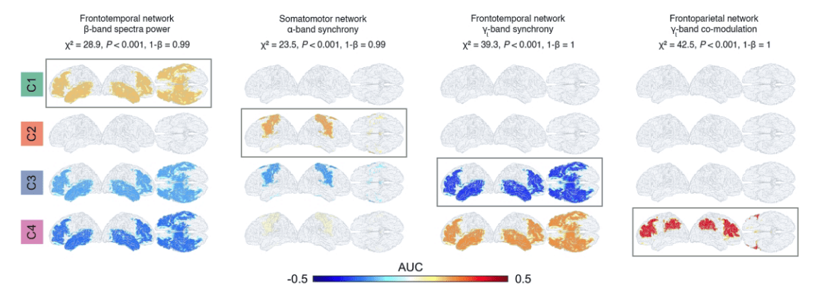 MND neurological patterns