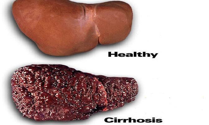 Cirrhosis