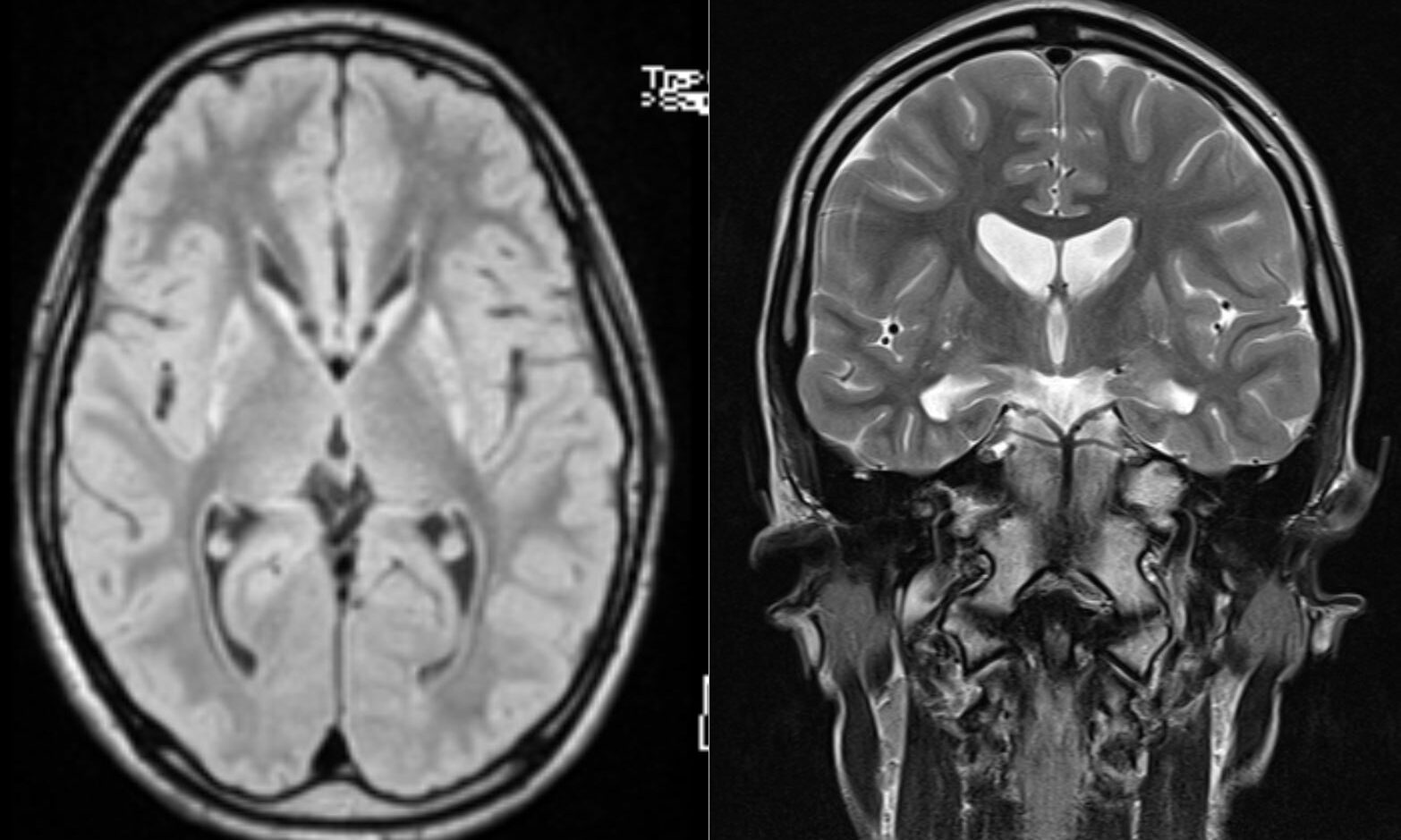 Huntington's disease