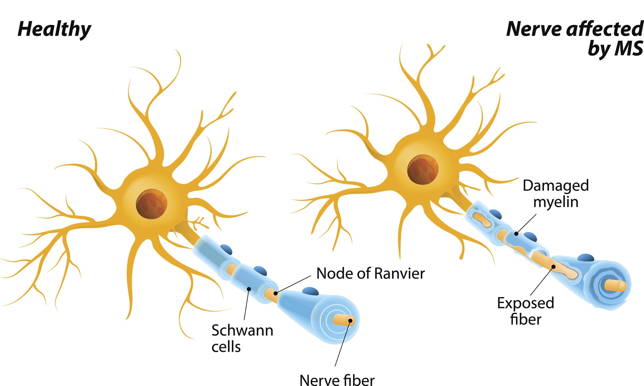 Multiple Sclerosis