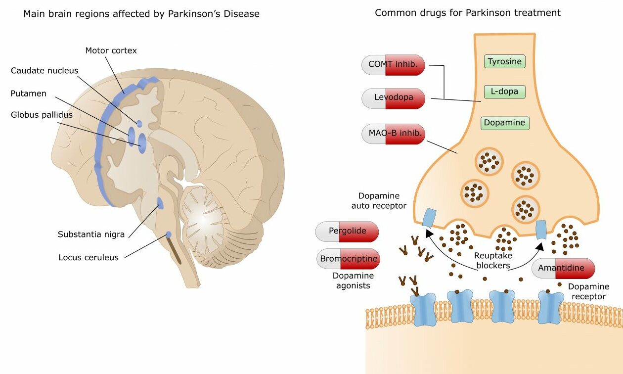 Parkinson's disease