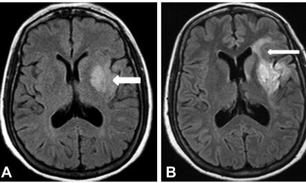 Stroke research