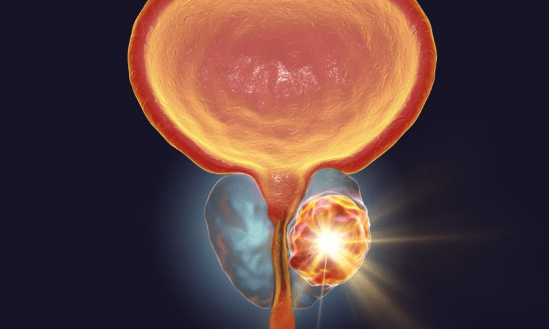 Prostate cancer biomarker